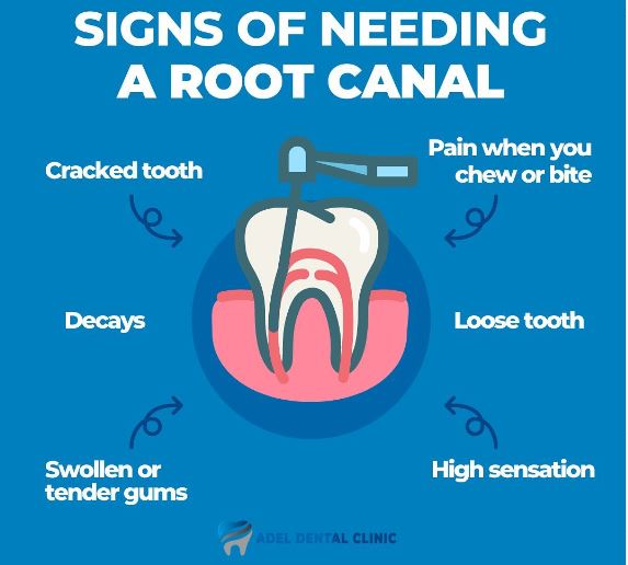 signs of needing root canal